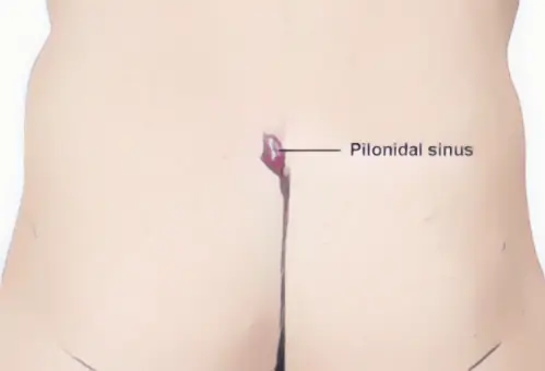 Pilonidal Sinus